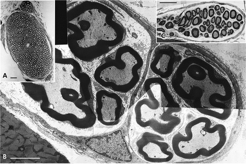 Figure 1. (a–c) Lean Fa/? Zucker rat sciatic nerve. One-micrometer thick sections of tibial branches of the sciatic with its epineurium (a,c). Toluidine blue stain. (a): Example of a large branch with tight fascicles contained in the perineurial sheath and two adjacent small branches. The central region contains an obvious vasa nervorum. In (c): A small intramuscular nerve subdivision. Scale in (a) and (b) is 10 µm. (b): TEM pane mounted out of nine micrographs of a further intramuscular branch of (c) demonstrating two small fascicles of five fibers each, surrounded by the epi- and perineurial fibers and an endoneurial loose connective tissue where nerve fibers show their densely contrasted myelin; the most folded ones likely denote their near- or paranodal region. Scale is 5 µm.