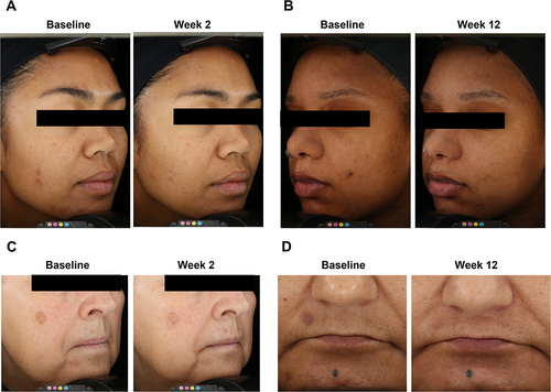 Figure 3 Four representative participants at baseline and Week 2 and/or Week 12 after Dark Spot Tx. (A) A 37-year-old woman with Fitzpatrick skin type IV and PIH. (B) A 25-year-old woman with Fitzpatrick skin type V and PIH. (C) A 64-year-old woman with Fitzpatrick skin type II and solar lentigines. (D) A 51-year-old woman with Fitzpatrick skin type IV and solar lentigines.