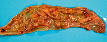 Figure 3. Caecum showing advanced ulcers filled with diphtheritic, necrotic debris.