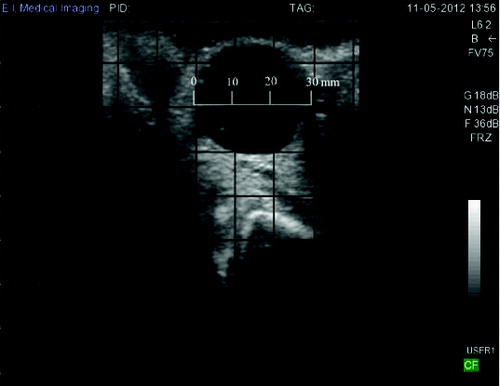 Figure 1. Ovarian ultrasound images of cow 1258. The cyst was diagnosed as a follicular cyst by the presence of a black fluid-filled cavity 30 mm in diameter that persisted throughout the monitoring period and failed to ovulate according to the criteria detailed by Leslie and Bosu (Citation1983).