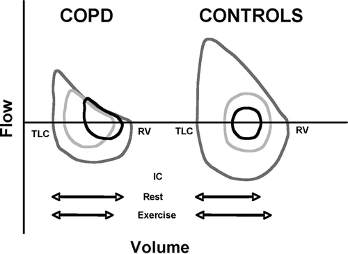 Figure 2 Examples of flow volume loops obtained in one healthy subject and one patient with COPD. Blue lines represent the maximal envelope, black lines depict the flow-volume loops at rest and the orange lines shows the flow-volume loops during exercise. Adapted with permission from O'Donnell DE, Banzett RB, Carrieri-Kohlman V, et al. Pathophysiology of Dyspnea in Chronic Obstructive Pulmonary Disease: A Roundtable. Proc Am Thorac Soc. 2007; 4:145–168. Official Journal of The American Thoracic Society. © American Thoracic Society.