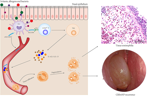 Figure 10 Hypothetical model showing association between ALCAM expression and eosinophil infiltration and recurrence in CRSwNP. On allergens derived from irritants and bacteria challenge, DCs were activated and the production of ALCAM was increased, releasing its soluble form (sALCAM). This promoted the ALCAM–CD6 interactions and enhanced Th2 immune responses, then induced the eosinophil tissue infiltration and aggravation of eosinophilic inflammation, resulting in tissue eosinophilia and recurrence in CRSwNP.