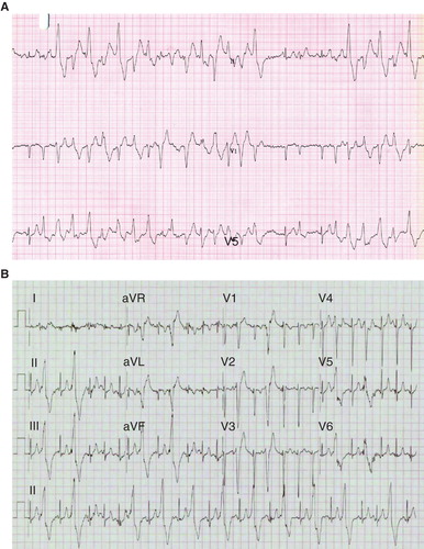 Figure 2. Rhythm strips of the proband and her daughter. A: Three lead rhythm strip (25 mm/s, 10 mm/mV) taken during exercise of the female proband (II-3), at age 29 years following presentation with exertional syncope. Two minutes into stage 1 of the Bruce protocol, there are runs of polymorphic ventricular ectopy and ventricular tachycardia interrupted with occasional sinus beats. B: 12 lead rhythm strip (25 mm/s, 10 mm/mV) taken during exercise of an asymptomatic 7-year-old daughter of the proband (III-3) in stage 3, 9 min into the Bruce protocol. Frequent left bundle branch, inferior axis monomorphic ventricular extra beats develop into bigeminy.