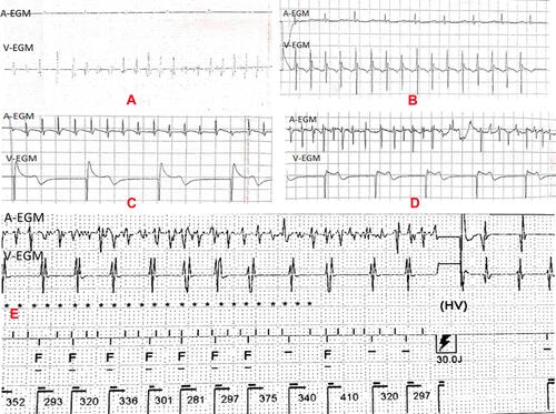 Figure 2 Intracardiac electrograms of arrhythmia. (A) Confirmed episode of SVT, A-A interval = 641–1289 ms, rate = 47–94 bpm; V–V interval = 172–273 ms, rate = 220–348 bpm; (B) Confirmed episode of NSVT, A-A interval = 590 ms (atrial pacing), rate = 47–94 bpm; V–V interval = 290–310 ms, rate = 194–207 bpm, duration = 4920 ms. (C) Confirmed episode of AT, regular A-A interval = 220 ms, rate = 273 bpm; V–V interval = 1000 ms (ventricular pacing), rate = 60 bpm; (D) confirmed episode of AF, A-A interval = 170–210 ms, rate = 286–352 bpm; V–V interval = 980 ms (ventricular pacing), 61 bpm. (E) False-positive example of electrograms (inEGMs) stored as VT/VF. The episode A-A interval= 80–240 ms, rate = 250–750 bpm; V–V interval = 281–410 ms, 146–213 bpm, according to intracavitary electrogram, according to inEGM, we diagnosed as AF with fast ventricular rate. Implantable device diagnosed this episode as VT/VF and given a 30J shock.