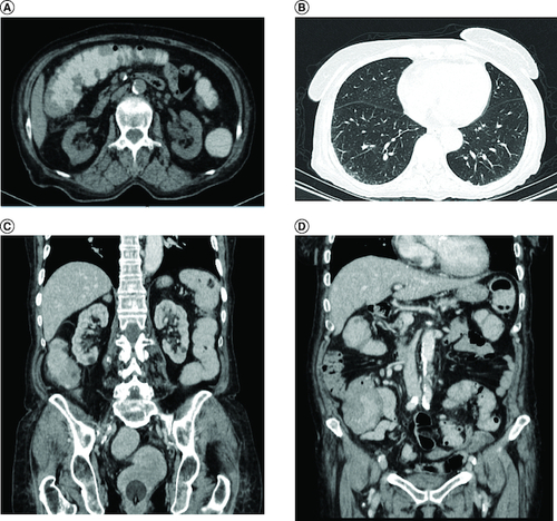 Figure 1. Coronal and axial scan.(A) Nodular thickening in the transverse and right colon, (B) adrenal nodes (23 × 31 mm) and latero cava lymphadenopathy, (C) thoracic CT scan shows no lymphadenopathy.