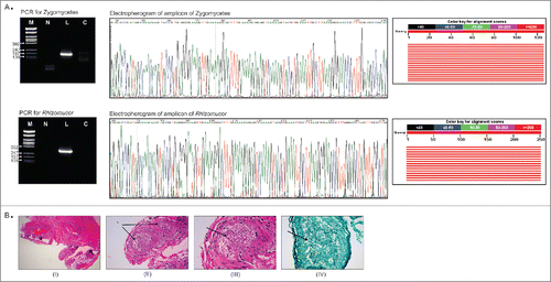 Figure 3. Validation of PathoChip screen results by PCR, sequencing and staining of infected tissue section. Fig. 3A shows the the PCR amplified products yielded using primers to detect any Zygomycetes fungi and primers to detect Rhizomucor, run on 2% agarose gel (left panel). Ethidium bromide stained gel picture of the amplicons are shown (left panel). M: ϕX174/Rsa1 DNA ladder, L: leukemic patient sample, C: control sample. Part of the electropherogram of the ampilcons sequenced is shown (middle panel). The NCBI BLAST tool showed alignement scores for each amplicon sequenced (right panel). The graphic summary shows alignments (as colored lines) of database matches to the amplicons sequenced (query). The red color lines represented the highest alignment scores, thus suggesting the query sequence to be significantly similar to the database hit Rhizomucor pusillus and Rhizomucor miehei 28S rRNA sequences. Fig. 3B shows the staining of tissue section from the patient for fungus. A Hematoxylin and Eosin (I-III) as well as Grocott Methanamine Silver (IV) stain were performed on the tissue sections from the paravertebral mass of the patient. Figure (I) shows the low power view of the soft tissue, (II) shows the 20X view, (III) shows the 40X view and (IV) shows the 40X view using silver stain (Grocott stain). Fungus in blood vessels is shown with arrows.