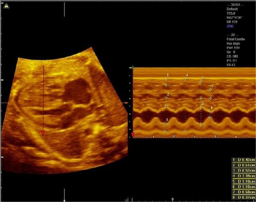 Figure 5 M mode of spatiotemporal image correlation showing measurements of fetal cardiac function. 1) Thickness of the wall of the left ventricle; 2) thickness of the interventricular septum; 3) thickness of the wall of the right ventricle; 4) external diameter of the two ventricles; 5) internal diameter of the left ventricle at the end of diastole; 6) internal diameter of the right ventricle at the end of systole; 7) internal diameter of the left ventricle at the end of systole; 8) internal diameter of the right ventricle at the end of systole.