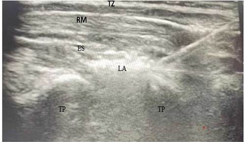 Figure 1 Ultrasound- guided demonstration of the erector spinae plane block. ES (erector spinae muscle); Tz (trapezius muscle); Rm (rhomboid major muscle) and TP (transverse processes) B, Needle shaft is apparent as a white line with local anesthetic (LA) deposited deep to the erector spinae muscle.