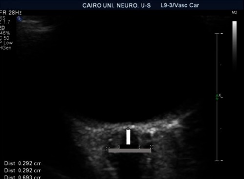 Figure 1 Sonographic measurement of the optic nerve diameter (black line) and the optic nerve sheath diameter (grey line), calculated by the distance between the two cursors measured 3 mm posterior to the globe (white line).