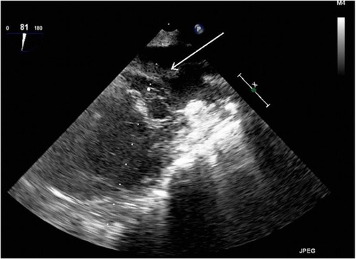 Figure 2 Transesophageal echocardiography (TEE) view with thrombus in left atrium before thrombolysis.