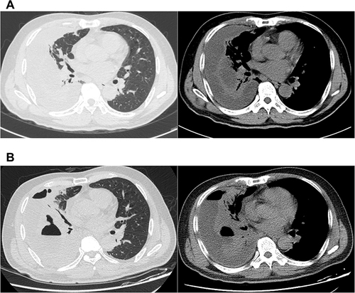 Figure 1 CT images the dead patient (case 6). (A) CT on admission showed bilateral pneumonia and a large right-sided encapsulated and separate pleural effusion. (B) CT repeated in the 10th day showed empyema and pneumonia aggravated, lung abscess and bronchopleural fistula were found.