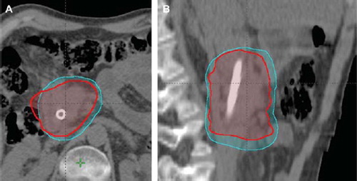 Figure 1. Comparison of PTV-STD (259.5 cm3; azure color) and 4D-PTV (185.0 cm3; red color) for patient number 15 on axial (A) and sagittal (B) views.