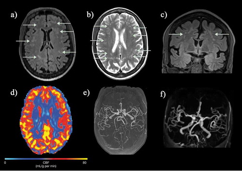 Figure 8. (a, b) Axial FLAIR and T2-weighted images and (c) coronal FLAIR images in a normally functioning 57-year-old female SCD patient with no neurological deficits who was scanned as part of a study and found to have widespread white matter lesions in the subcortical and deep white matter regions. (d) Cerebral blood flow map (CBF) map showed slightly reduced perfusion anteriorly and (e, f) intracranial MRA was entirely normal. FLAIR = fluid attenuated inversion recovery