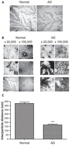 Figure S3 Precipitation pattern of AuNP–Aβ42 incubated with sera from normal and AD patients. Images were taken before TEM analysis in Figure 6.Abbreviations: AD, Alzheimer’s disease; Aβ42, amyloid β42; AuNP, gold nanoparticle; TEM, transmission electron microscopy.