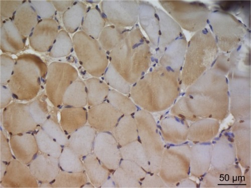 Figure 4 In the micrograph of the ischemia reperfusion + picroside II group, brown staining is observed in apoptotic cell nuclei showing immunoreaction by TUNEL staining. Magnification: ×400.