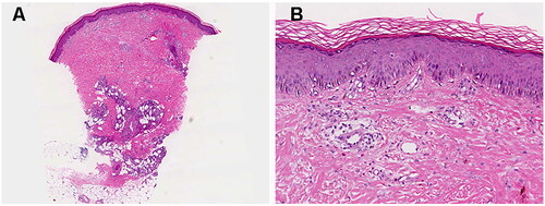 Figure 2. Histological findings of the patient. (A) A pattern of inflammatory cell infiltration in both the superficial and deep dermal layers, accompanied by mixed lobular and septal panniculitis; (B) A predominance of lymphocytes, neutrophils, and eosinophils within the inflammatory infiltrate. Hematoxylin and eosin, original magnification: (a) ×20; (b) ×100.
