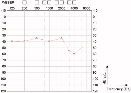 Figure 2. Hearing thresholds with the ABI, six years after implantation.