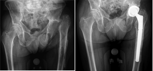 Figure 1. After explantation of total hip prosthesis and after final reimplantation of a new prosthesis.