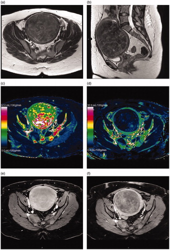Figure 2. T2 weighted MR images of a uterine fibroid in (a) axial and (b) sagittal plane. Quantitative blood flow maps of the same fibroid in axial plane (c) without oxytocin and (d) with oxytocin. Contrast enhanced T1 weighted MR images of the same fibroid in axial plane (e) without oxytocin and (f) with oxytocin.