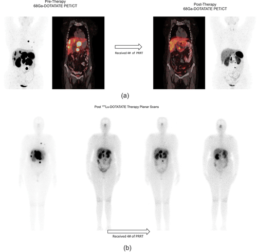 Figure 4. Favorable response to 177Lu-DOTATATE PRRT. (a) Baseline 68Ga-DOTATATE PET/CT scan (left panel MIP and fused PET/CT images) showed SSTR expressing multiple liver lesions, para-aortic nodes and lung nodules (Krennings score 4), she received 4# of PRRT (cumulative dose of 720 mCi) and showed resolution of almost all liver lesions, the other lesions also showed reduction in size in response evaluation 68Ga-DOTATATE PET/CT scan (right panel MIP and fused PET/CT images). (b) Post-177LuDOTATATE Therapy planar gamma camera images showing adequate accumulation of tracer in lesions (corroborating with pre-therapy 68Ga-DOTATATE PET/CT) and physiological tracer accumulation sites such as kidney.