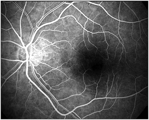 Figure 1. Capillary phase of retinal fluorescent angiography. Source: courtesy of B. Link.