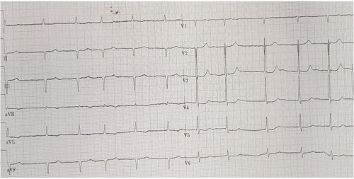 Figure 1 Baseline 12 leads ECG of our patient revealing atrial fibrillation with normal ventricular response (70 beats per minute), pseudoinfarction pattern in the inferior (QS complex in DII, DIII, aVF) and anterior (QS complex in V1-V2) leads, a normal voltage of the QRS complex and secondary changes of ST-T.
