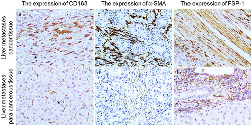 Figure 3 Representative immunohistochemical staining of CD163, α-SMA, and FSP-1 in cancer tissues and paracancerous tissues of liver metastases in the experimental group (200x field of view). (a) CD163 expression in liver metastases cancer tissues of the experimental group (Arrows mark M2-type macrophages). (b) Expression of CD163 in paracancerous tissues of liver metastases in the experimental group (Arrows mark M2-type macrophages). (c) Expression of α-SMA in cancerous tissues of liver metastases in the experimental group. (d) Expression of α-SMA in paracancerous tissues of liver metastases in the experimental group. (e) Expression of FSP-1 in cancerous tissues of liver metastases in the experimental group. (f) Expression of FSP-1 in the paracancerous tissues of liver metastases in the experimental group.