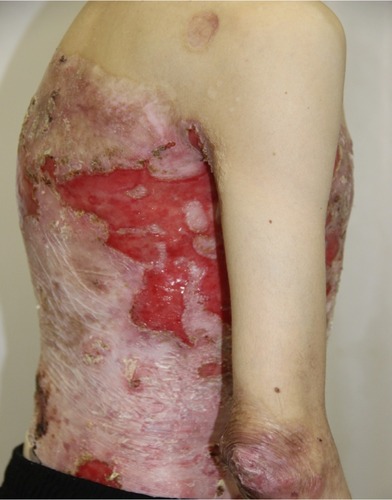 Figure 6 Appearance of lesions on the patient’s lateral abdomen on presentation.