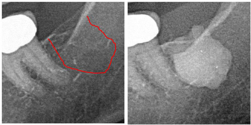 Figure 4 Left panel: 2D X-ray diagnostics of area 38. Right panel: Documentation of the expanse of FDOJ in retromolar area 38/39 using a contrast agent after FDOJ surgery.