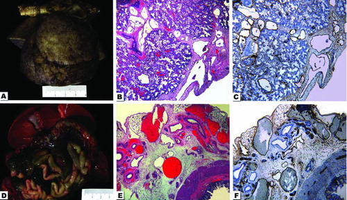 Figure 1.  Composite photograph with gross and photomicrographs from the autopsy. A. The lungs after 24 h of formalin fixation. When fresh, they were pale pink with a slightly bumpy pleural surface. The aorta is horizontally placed at the upper portion of the photograph. B. Hematoxylin-and eosin (H&E)-stained photograph taken from the lung with the 4× -lens depicts the pleural surface and part of the pulmonary parenchyma. Notice the dilated vessels. C. Same field of view and magnification as in 1-B, but stained by immunohistochemistry for D2-40 highlights the lymphatic origin of dilated vessels. D. The upper part of the abdominal organs demonstrates the liver with gallbladder, intestine and congested mesenteric vessels. E. The H&E-stained photomicrograph from intestine and mesentery with the 4× -lens shows the intestine in the right lower corner and numerous dilated mesenteric vessels. F. Same field of view and magnification as in 1-E, but stained by immunohistochemistry for D2-40 highlights the lymphatic nature of dilated vessels.