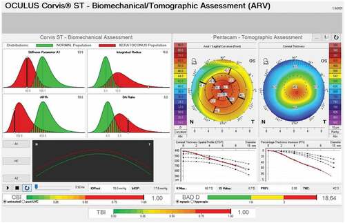 Figure 2. Tomographic biomechanical display (TBI) from Pentacam and Corvis ST showing abnormal corneal biomechanics and abnormal CBI, BAD D and TBI values indicative of keratoconus.