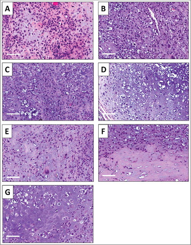Figure 6. Effect of treatment on osteosarcoma lung metastasis PDOX tumor histology. A) Hematoxylin and eosin (H&E)-stained section of the original patient lung metastasis. B) Untreated PDOX tumor. C) PDOX tumor treated with CDDP. D) PDOX tumor treated with rMETase. E) PDOX tumor treated with S. typhimurium A1-R. F) PDOX tumor treated with S. typhimurium A1-R combined with rMETase and G) PDOX tumor treated with S. typhimurium A1-R combined with both rMETase and CDDP. White scale bars: 80µm.