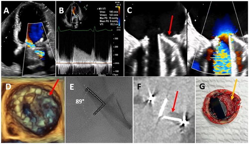 Figure 3. Transthoracic echocardiography in a patient with mechanical prosthetic valve mitral valve replacement for systemic lupus erythematosus-induced Libman-Sacks endocarditis. (A) turbulent eccentric diastolic mitral inflow; (B) mean 9-mmHg pressure gradient; C-F: posterior leaflet stuck in closed position and a prosthetic mitral thrombus (arrow). (C and D) trans-esophageal echocardiography; € cinefluoroscopy; (G) cardiac computed tomography (from reference [Citation26]).
