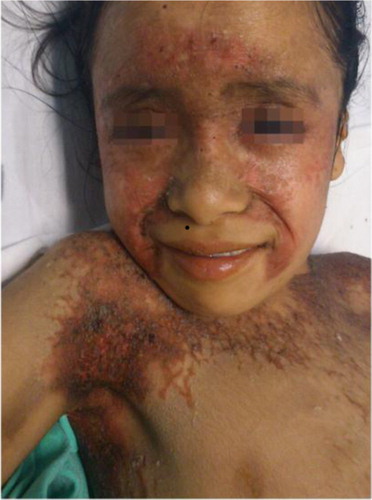 Fig. 1 Cutaneous manifestations of pellagra. Thickened, scaly, and hyperpigmented skin on the photoexposed areas of the face in a girl with Ehlers–Danlos disease.