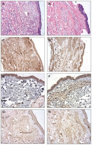 Figure 2 Photomicrograph of a skin biopsy. (A) Infiltrate of histiocytes surrounded by lymphocytes in the dermis in a case of MB leprosy before the BCG-id (HE, ×100). (B) Tendency towards granuloma formation in a case of MB leprosy after the BCG-id (HE, ×100). (C) Immunoreactivity for INFγ in a case of MB leprosy before the BCG-id (NovoLink staining with hematoxylin counterstaining, ×50). (D) Immunoreactivity for INFγ in a case of MB leprosy after the BCG-id (NovoLink staining with hematoxylin counterstaining, ×50). (E) Immunoreactivity for IL-1 in a case of MB leprosy before the BCG-id (NovoLink staining with hematoxylin counterstaining, ×100). (F) Immunoreactivity for IL-1 in a case of MB leprosy after the BCG-id (NovoLink staining with hematoxylin counterstaining, ×100). (G) Immunoreactivity for IL-10 in a case of MB leprosy before the BCG-id (NovoLink staining with hematoxylin counterstaining, ×100). (H) Immunoreactivity for IL-10 in a case of MB leprosy after the BCG-id (NovoLink staining with hematoxylin counterstaining, ×100).