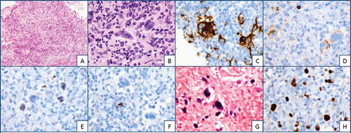 Figure 2. Biopsy specimen demonstrating a patchy but focally dense lymphoid infiltrate (a).Predominantly composed of small lymphocytes with admixed large atypical cells resembling Hodgkin/Reed-Sternberg cells (b). Immunohistochemistry demonstrating CD30 positive staining (c). CD 15 staining (d). Dim Pax-5 (e). Occasional dim CD 20 expression in H/RS cells (f). Lymphoid infiltrate containing mixture of CD3/CD5 positive T cells and CD-20 positive B cells, with predominating T cells. An in situ hybridization for EBV-encoded RNA (EBER) positive in H/RS cells (g). Ki-67 proliferation index is overall low, but significantly increased in H/RS cells (h)