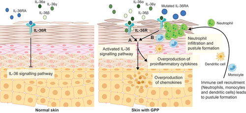 Figure 1. IL-36 signaling pathway in normal skin and in skin with GPP.