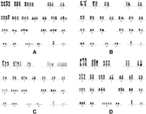Figure 3 A, B, C, and D represent the initial, second, third and fourth results taken during conventional cytogenetic analysis of bone marrow. RHG-banded metaphases were analysed and karyotyped according to ISCN (2013). (A) Karyotype on 25 December 2015, LTSC showing:66~68, XY,+Y,+1,+1,+2,+3,+3,+4,+6,+6,+7, +8,+9, +11,+12, +13,+15, +16,+17,+21, +21,+21[cp10]/46, XY[3]. (B) Karyotype on 1 April 2016, USSTC showing less cells with poor proliferation: 46, XY[8]. (C) Karyotype on 11 May 2016, LTSC showing 55~65, XY,+Y, +1,+2, +2,+4, +5,+5,+5,+8, t(9;22)(q24; q11.2), +13,+14, +14,+15, +16, +17,+20,+21,+der(22)t(9;22)[cp14]/46, XY[6]. (D) Karyotype on 14 June 2016, LTSC showing 57~59, XY,+Y,+1,+2,+3,+6,+8, add(11)(p15), +13,+15,+16,+19,+21,+21, +21[cp20].
