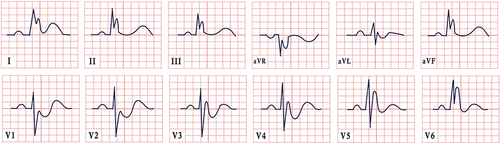Figure 4 ECG features in Osborn syndrome, presenting sinus rhythm, normal cardiac axis, and the characteristic diffuse J point with R’ aspect.
