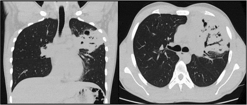 Figure 1. Chest CT scan, evidence of S3 consolidation, and cavitation of the left hemithorax.