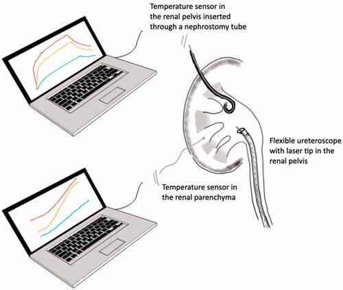 Figure 1. Experimental set-up with porcine kidney, temperature sensors and flexible ureteroscope with laser fiber.