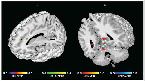 Figure 4. Emotional recognition memory (ER) task. Regions showing differences in neural activity in the PRP group as compared to control groups, a) N>B contrast, b) U>B contrast. Results are reported at p < 0.05 corrected for multiple comparisons using Alphasim corrections. (LG: Lingual gyrus; CG: Calcarine gyrus; AnC: anterior cingulum).