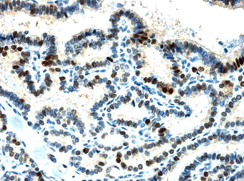 Figure 1.  Cyclin D1 staining of papillary microcarcinoma (×200)