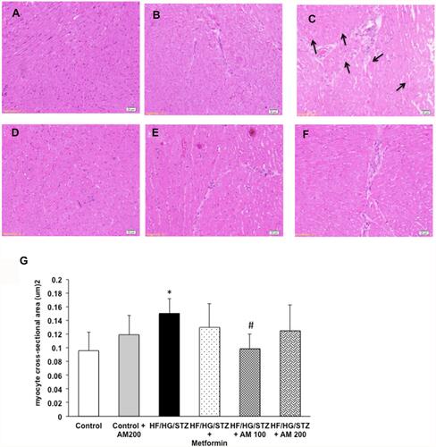 Figure 3 Effects of alpha-mangostin on histopathological changes. (A–F) Hematoxylin and eosin staining of the cross-sectional tissue slices of left ventricular depicting cardiomyocyte hypertrophy (×200). (A) control; (B) control-treated with AM 200; (C) HF/HG/STZ; (D) HF/HG/STZ + Metformin; (E) HF/HG/STZ + AM 100; (F) HF/HG/STZ + AM 200. Arrows in (C) indicate cardiomyocyte hypertrophy. (G) Bar graph shows quantitative analysis of cross-sectional area. Results are represented as mean ± SD and were analyzed using one-way ANOVA followed by Tukey’s post-hoc analysis. Values are considered significantly different at p < 0.05. *p < 0.05 HF/HG/STZ vs control and control-treated with alpha-mangostin. #p < 0.05 HF/HG/STZ vs HF/HG/STZ + AM 100.