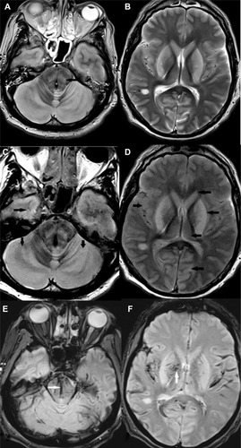 Figure 1 Unenhanced axial T2-weighted (A and B), fluid attenuated inversion recovery (C and D), and T2*-weighted (E and F) images showing hyperintensities involving the cerebral and cerebellar cortex and white matter, basal ganglia, thalami, and brainstem bilaterally (solid black arrows). A focal hyperintense lesion is noted in the right temporal periventricular white matter (open black arrow). Petechial hemorrhages are noted in the brainstem and gangliocapsular regions bilaterally (white arrows).