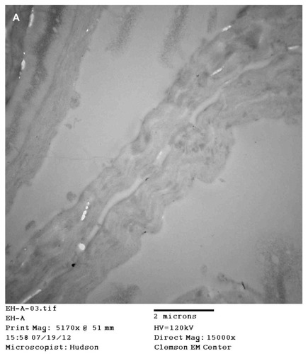 Figure 6 (A) Transmission electron microscopy (TEM), demonstrating longitudinal section of filament from patient 4. Note hollow medulla surrounded by a cortex. Scale bar is shown at bottom of TEM. (B) TEM of bovine digital dermatitis (BDD) section showing both longitudinal and cross sections of spirochetes. Scale bar is shown at bottom of TEM.