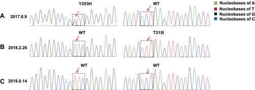 Figure 1 Y253H and T315I mutation in the ABL1 kinase domain were detected by PCR-direct sequencing before and after anti-CD19 CAR-T treatment. (A) Y253H mutation in the ABL1 kinase domain was identified in the patient after imatinib treatment for half a year. (B) T315I mutation was identified about half a year after switching from imatinib to dasatinib, while Y253H was undetectable. (C) No mutations were identified after chemotherapy followed by anti-CD19 CAR-T therapy. Colors green, red, black and blue represent nucleobases of A, T, G and C, respectively.