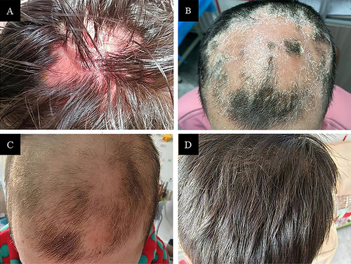 Figure 1 (A) Hair loss observed after starting therapy with secukinumab. (B) Alopecia areata was evident after completing the induction period (5 weeks) of secukinumab. Gradual improvement of Alopecia areata after 3 months (C) and 8 months (D) of secukinumab discontinuation and treatment with tofacitinib.