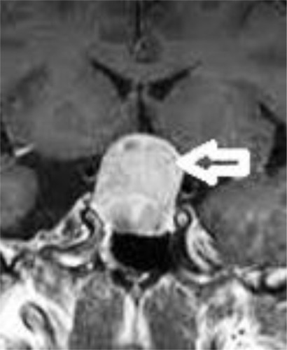 Figure 3 Coronal view, post-contrast T1 brain magnetic resonance imaging, showing a pituitary macroadenoma with compression of the optic chiasm (arrow).