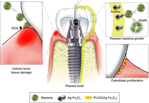 Scheme 1 Schematic diagram of PLGA(Ag-Fe3O4)-coated on dental implants.Notes: Bacterial infection (such as the one by Streptococcus mutans) activates host immune response to produce ROS, leading to the destruction of the tooth supporting tissues (left). In the planted tooth (center) covered with PLGA(Ag-Fe3O4), bacterial adhesion ability weakened (top right). Thus, the immune system did not produce ROS and the microenvironment around the planted area stimulated osteoblast proliferation and improved the transplant success rate (bottom right).Abbreviations: PLGA, poly (D, L-lactic-co-glycolic acid); ROS, reactive oxygen species; N, magnetic north pole; S, magnetic south pole.